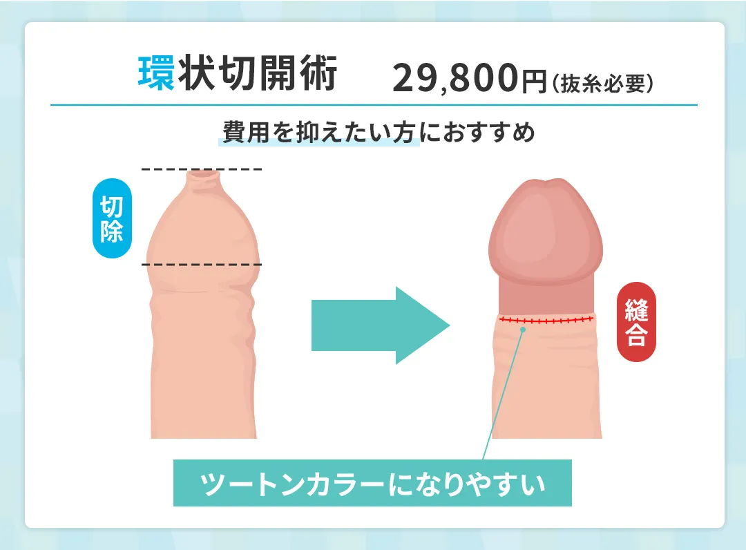上野クリニックの環状切開術